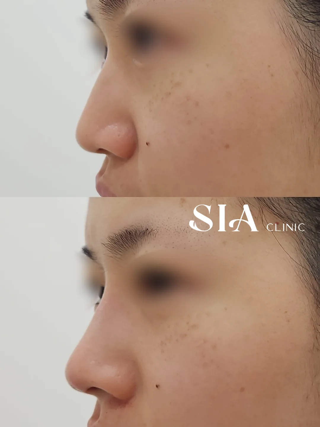 始雅 SIA 女性鼻部线雕局部官方术前术后案例