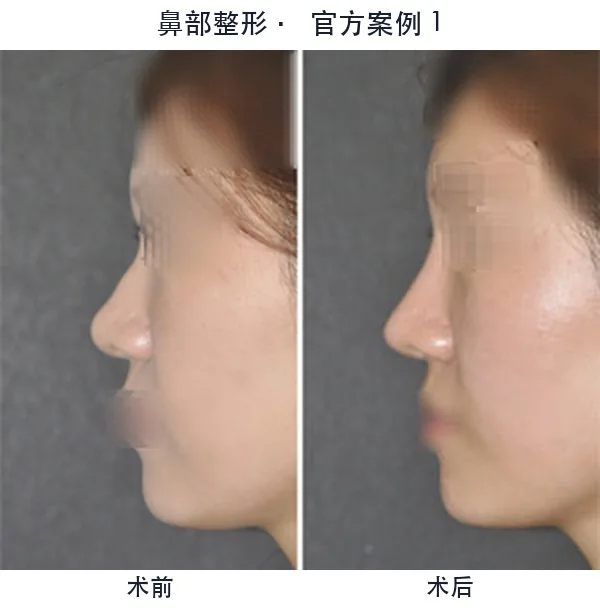 WILL Plastic Surgery Clinic Before-and-after cases 1