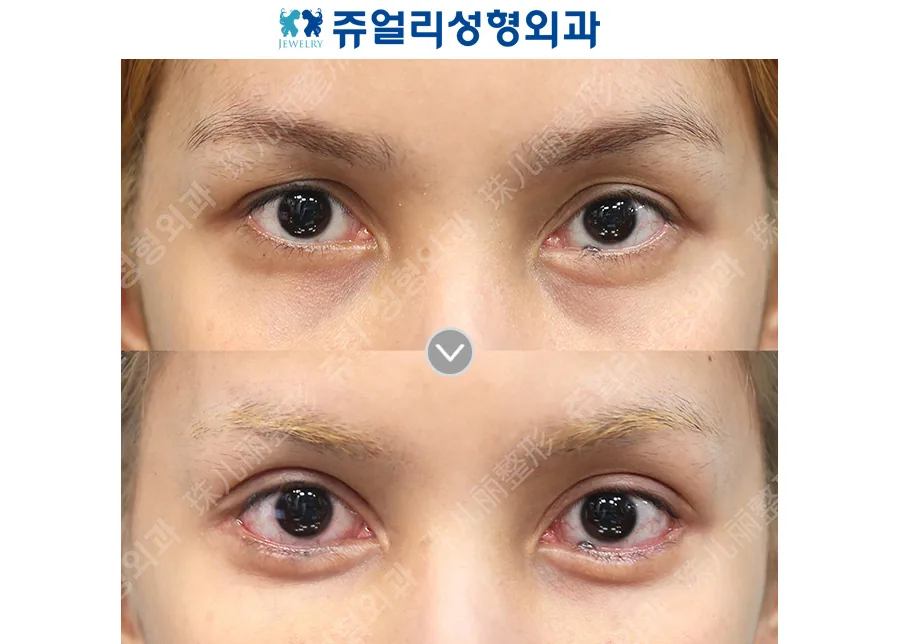 Jewelry Plastic Surgery Before-and-after cases 3