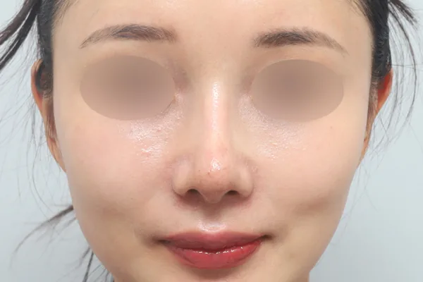 鼻部整形案例1术后3个月