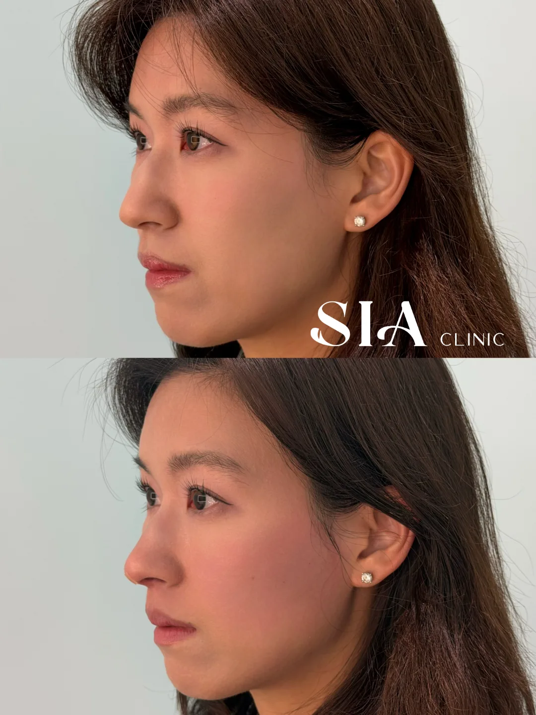 始雅 SIA 女性鼻部线雕侧面官方术前术后案例