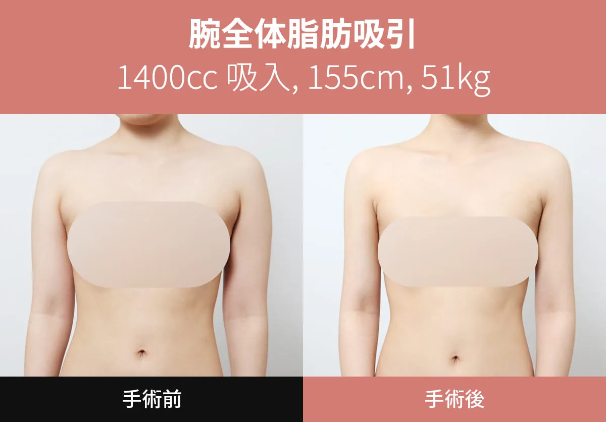 韩国N-slim吸脂医院全臂吸脂术前术后对比