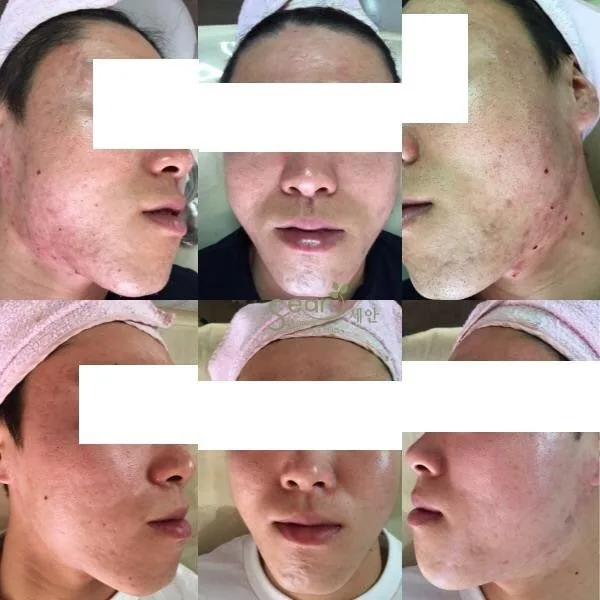 Lohas皮肤科院方前后案例 3