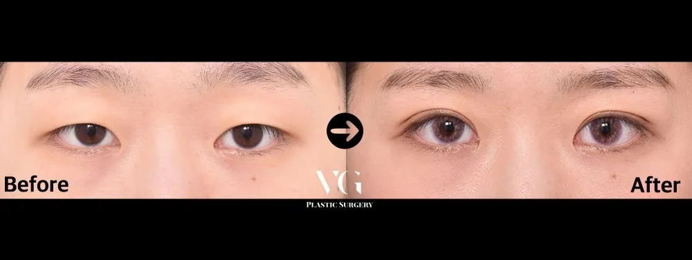 Very Good Plastic Surgery Before-and-after cases 12