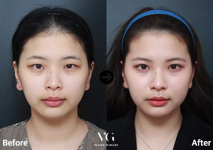 Very Good Plastic Surgery Before-and-after cases 11