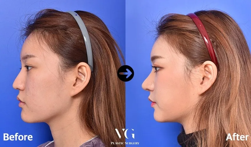 Very Good Plastic Surgery Before-and-after cases 4