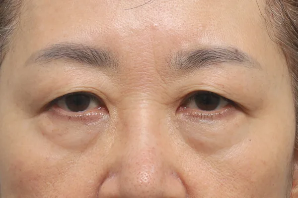 眼部整形案例1术前
