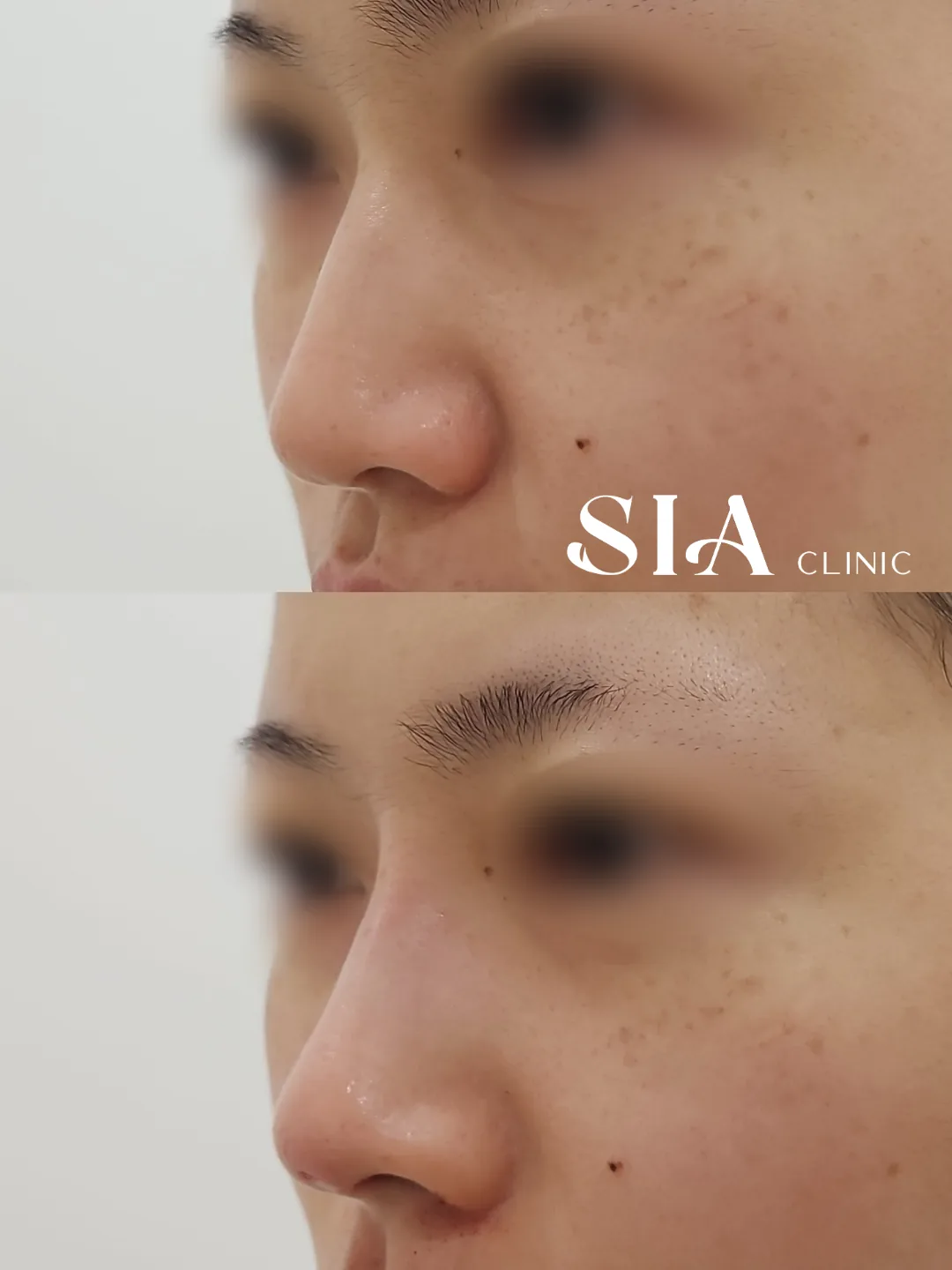 始雅 SIA 男性鼻部线雕侧面官方术前术后案例