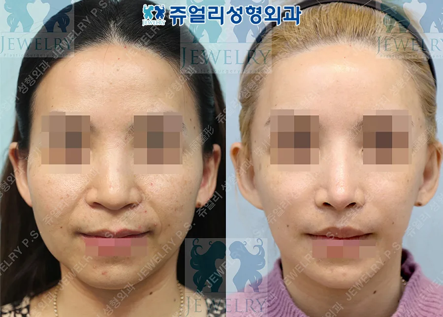 Jewelry Plastic Surgery Before-and-after cases 6
