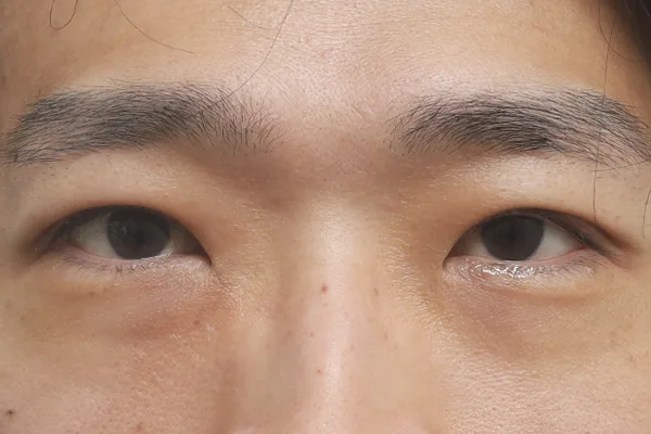 眼部整形案例2术后1个月