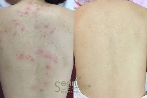 Lohas皮肤科院方前后案例 1