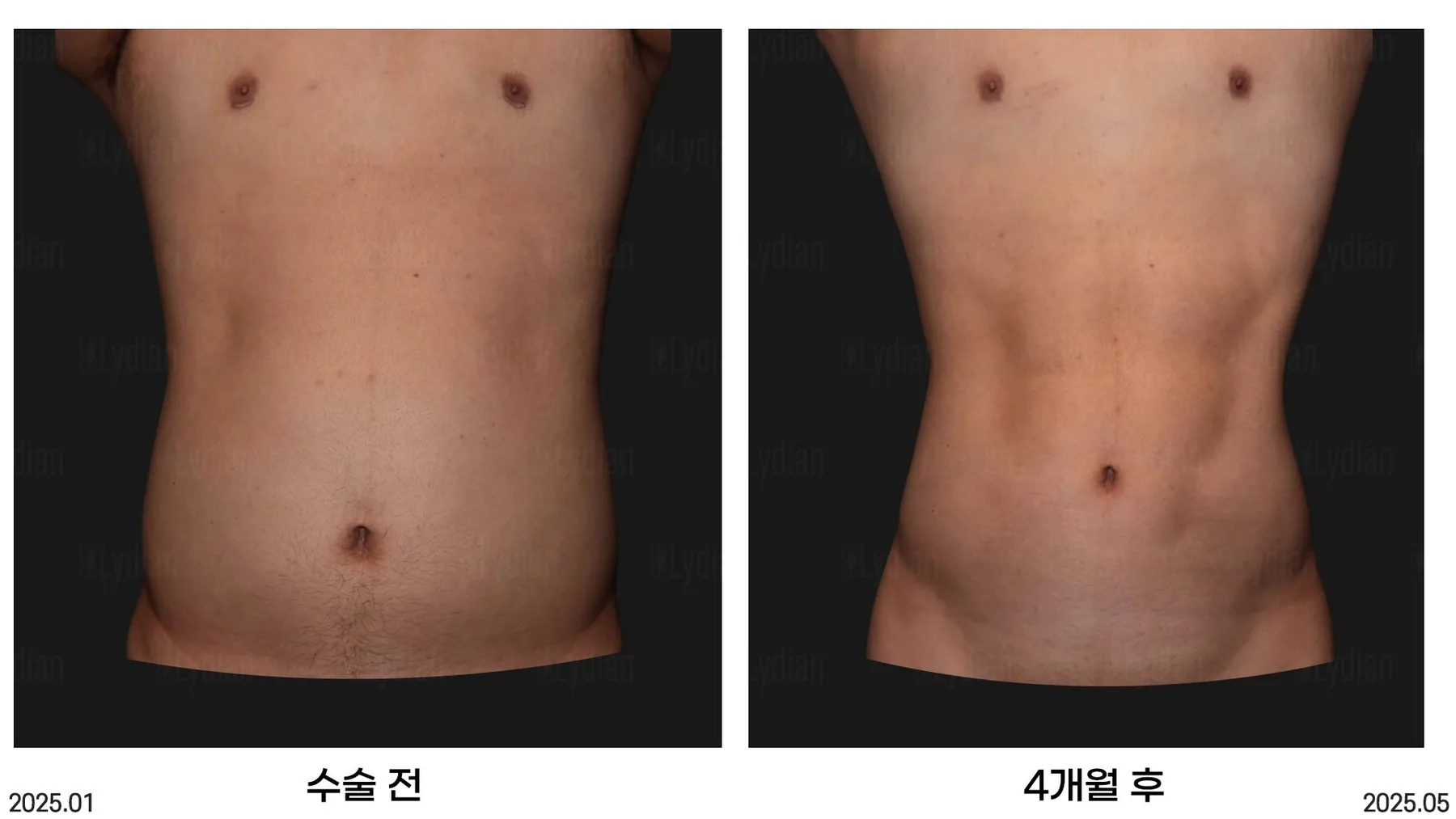 韩国丽迪安医院男性腹部线条塑形术前术后4个月案例