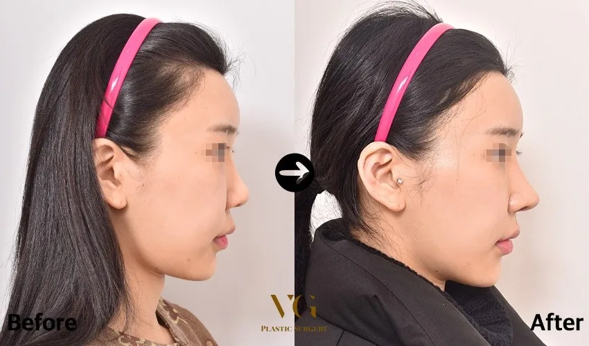 Very Good Plastic Surgery Before-and-after cases 5