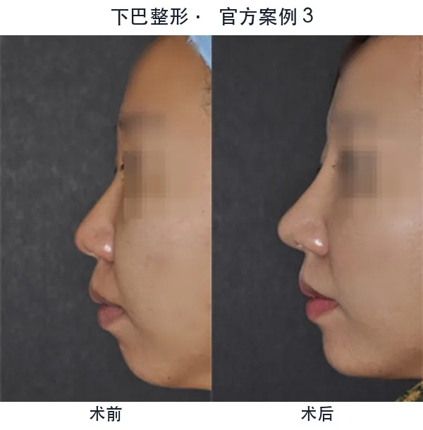 WILL Plastic Surgery Clinic Before-and-after cases 12