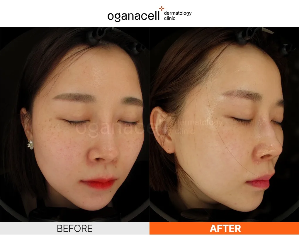 奥嘉娜Oganacell官方色斑与肤色改善术前术后对比案例 3