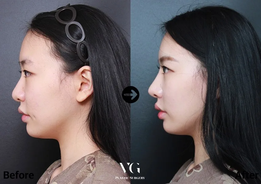 Very Good Plastic Surgery Before-and-after cases 6