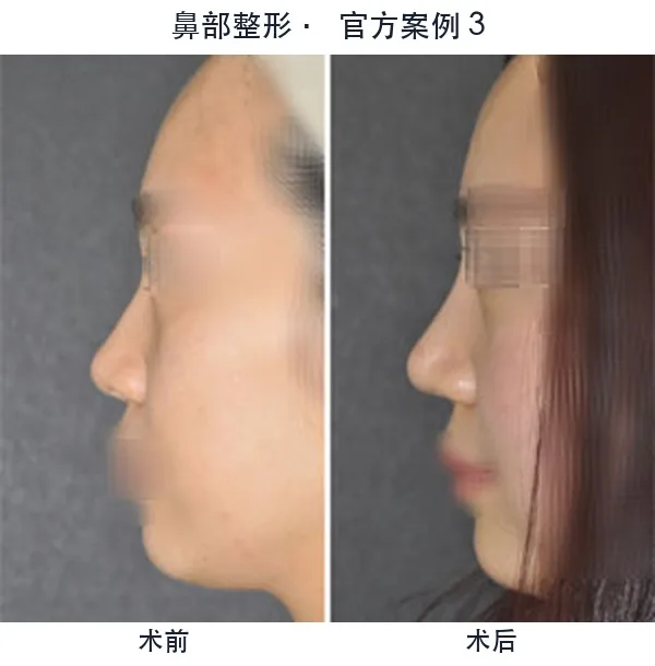 WILL Plastic Surgery Clinic Before-and-after cases 3