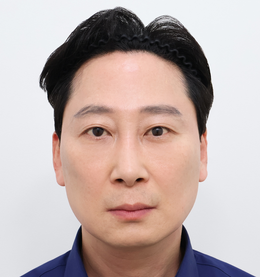 韩国普爱德整形外科迷你面部提升术后6个月真实照片