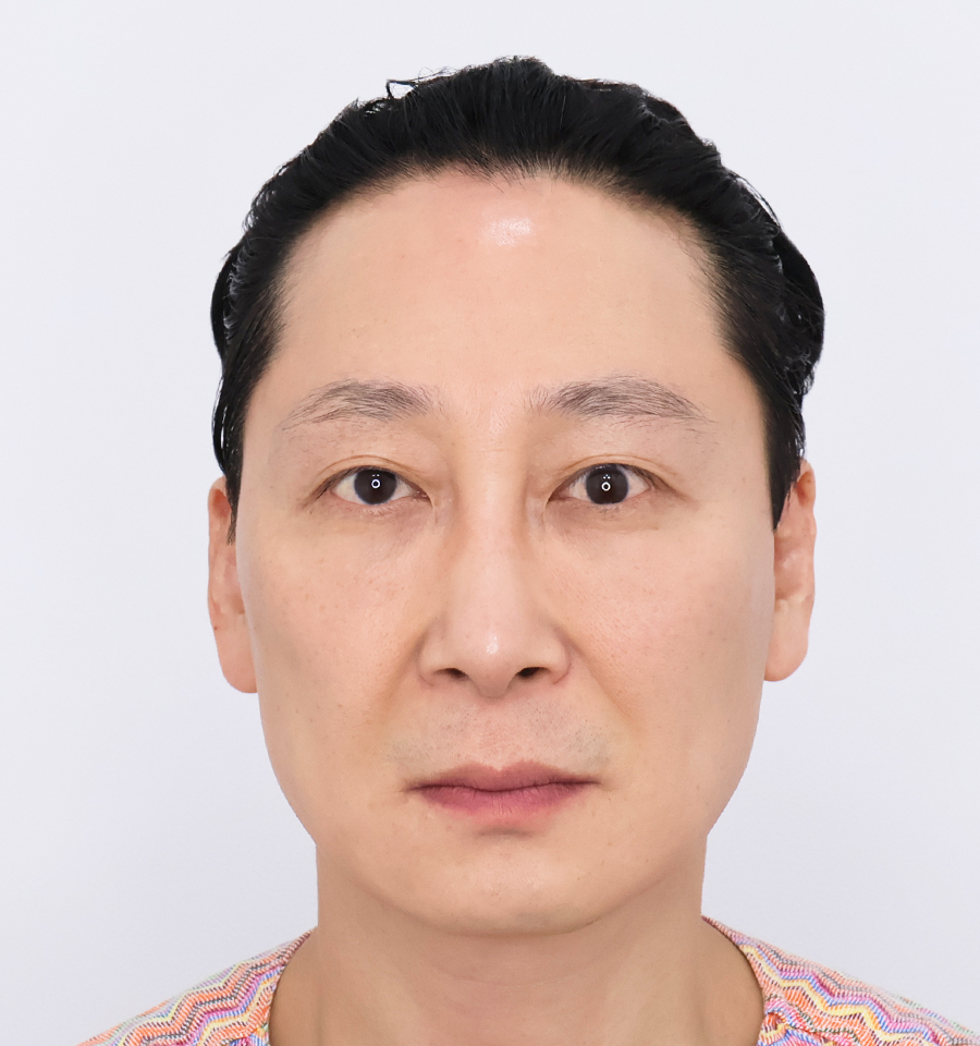 韩国普爱德整形外科迷你面部提升术前真实照片