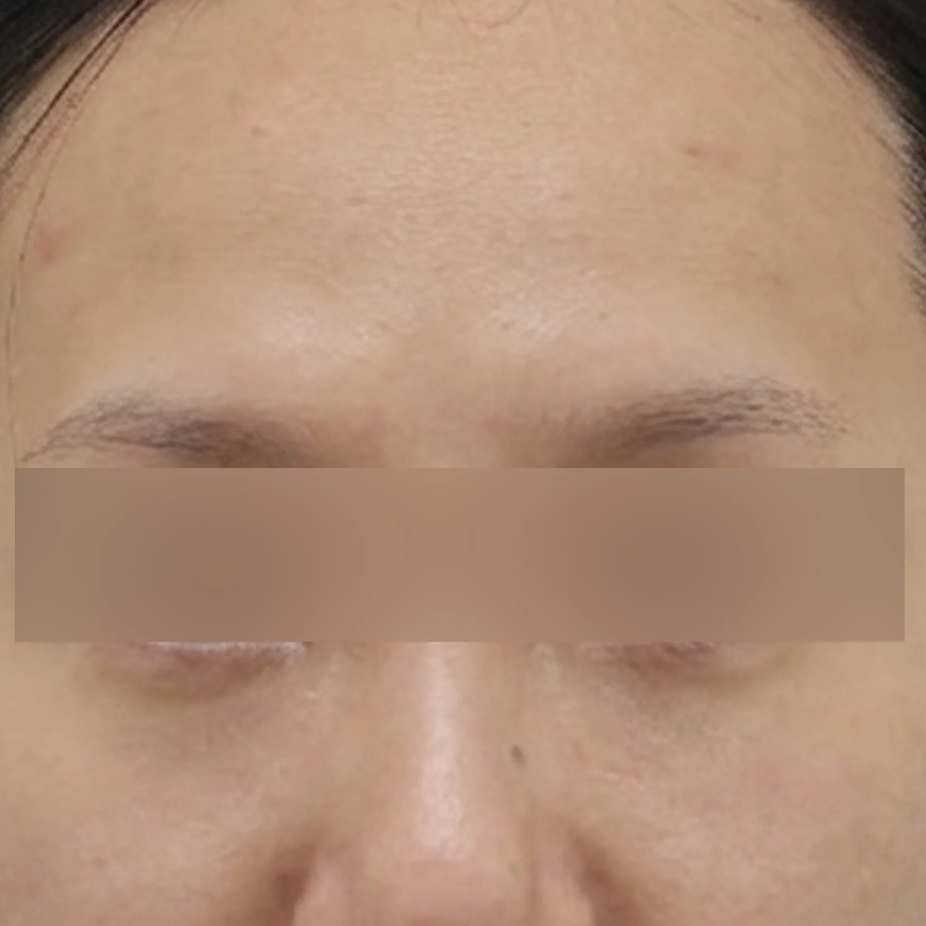 眼周综合方案术后案例二