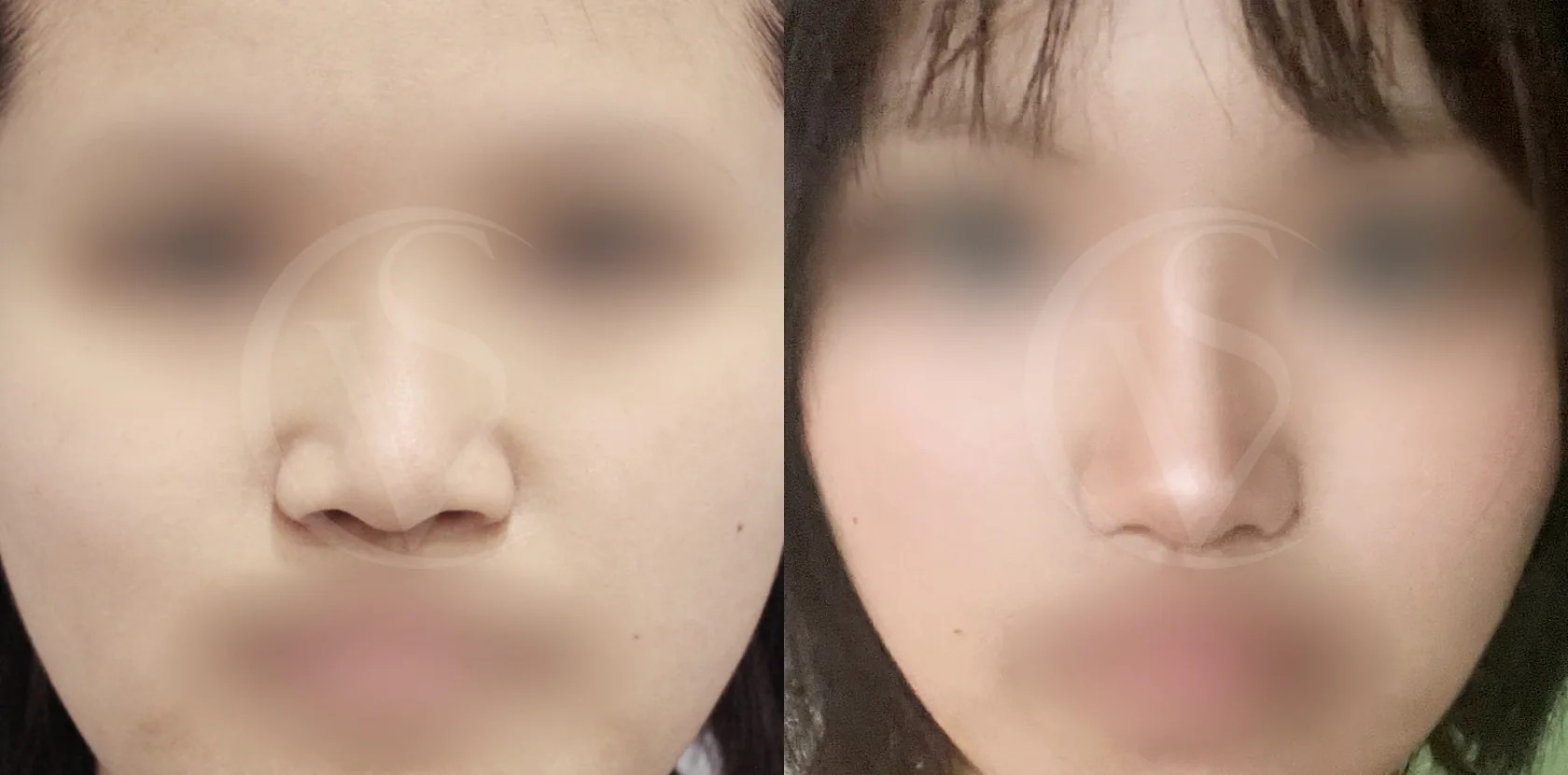 공식 전후 사례 2