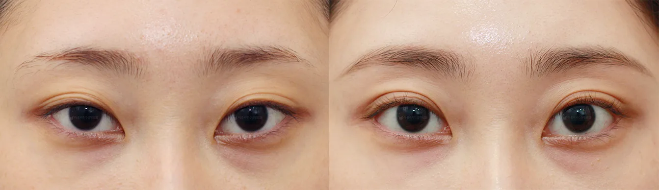 Official before-and-after cases 5