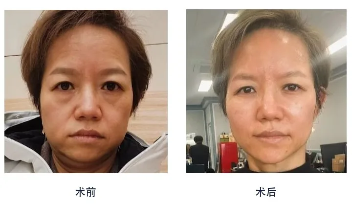 Official before-and-after cases 1