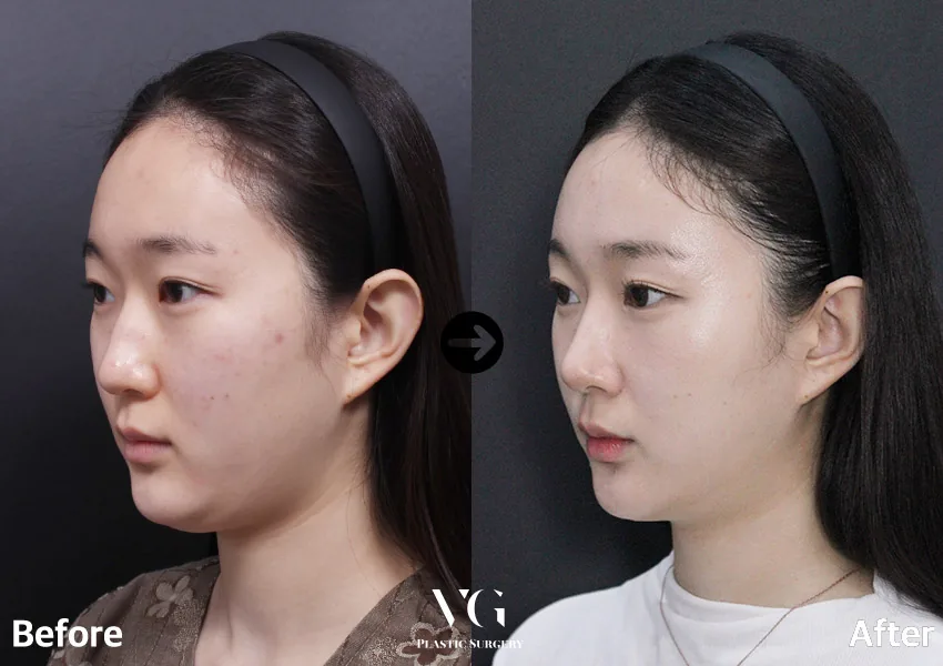 Very Good Plastic Surgery Before-and-after cases 7