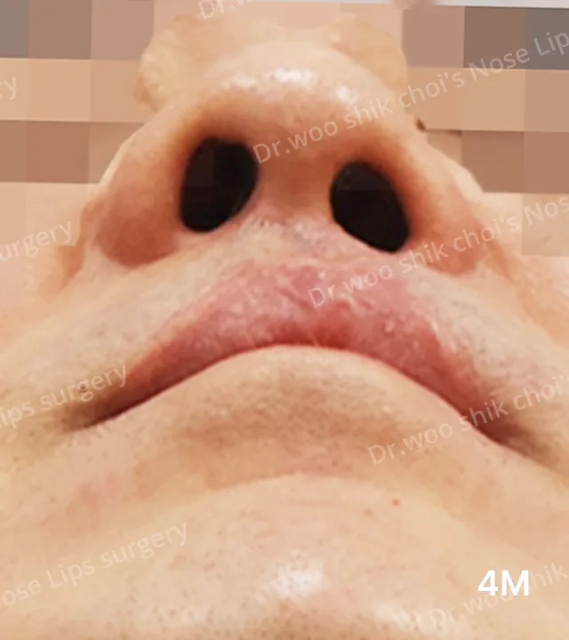 唇腭裂鼻唇人中畸形修复术后4个月