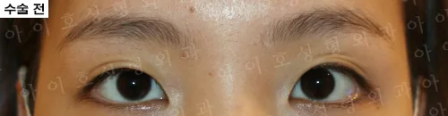 爱护整形外科埋线双眼皮及开内眼角术前