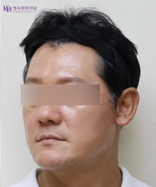 面部轮廓线与法令纹埋线提升术前