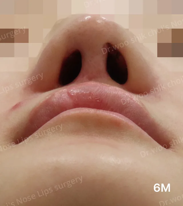 挛缩鼻及鼻孔不对称修复术后6个月