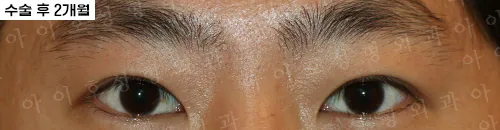 爱护整形外科切开双眼皮及眼型矫正术后2个月