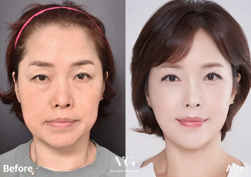 Very Good Plastic Surgery Before-and-after cases 22