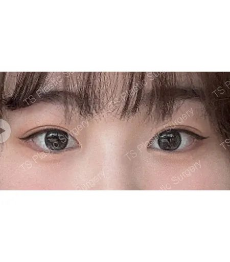 切开双眼皮术后