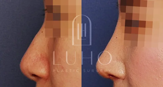Luho鼻梁鼻尖整形术后1个月案例二
