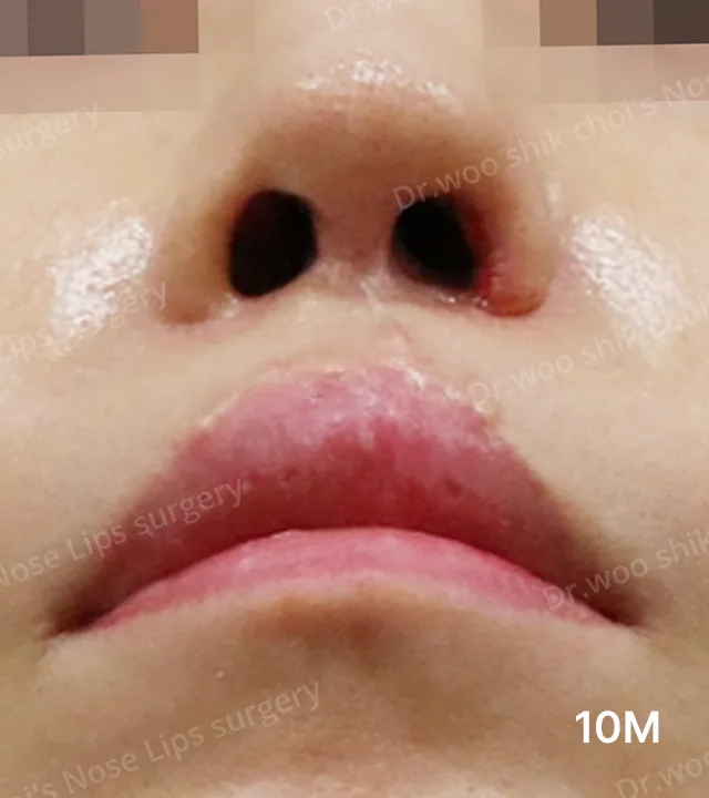 挛缩鼻及鼻孔不对称修复术后10个月