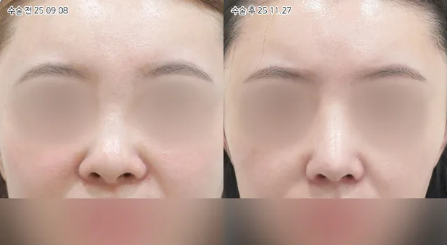 공식 전후 사례 4