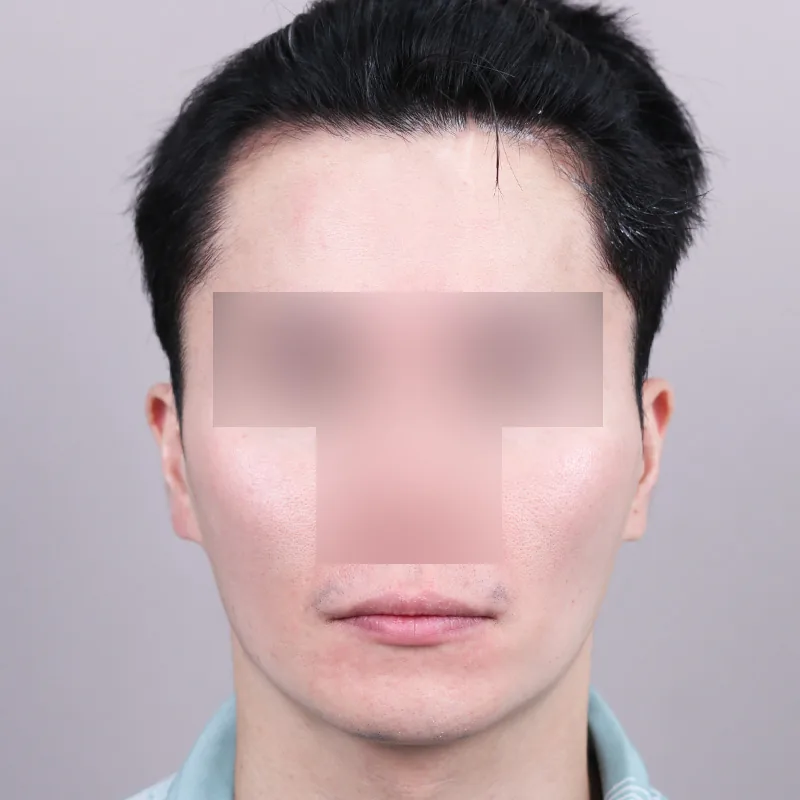 官方術前術後案例 11