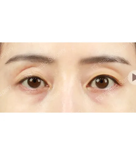 不对称眼型综合矫正术前
