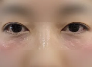 眼下填充术后案例二