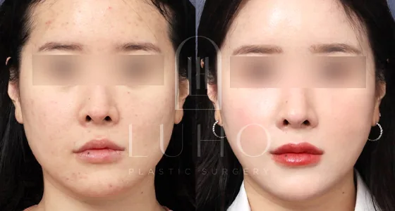 Luho线雕提升术后1个月案例三