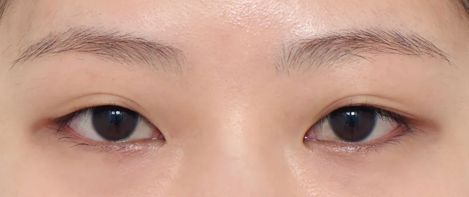 OVVE自然粘连复合眼部整形术前