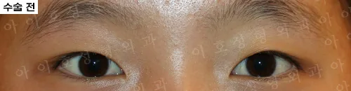 爱护整形外科埋线双眼皮及开内眼角术前案例二