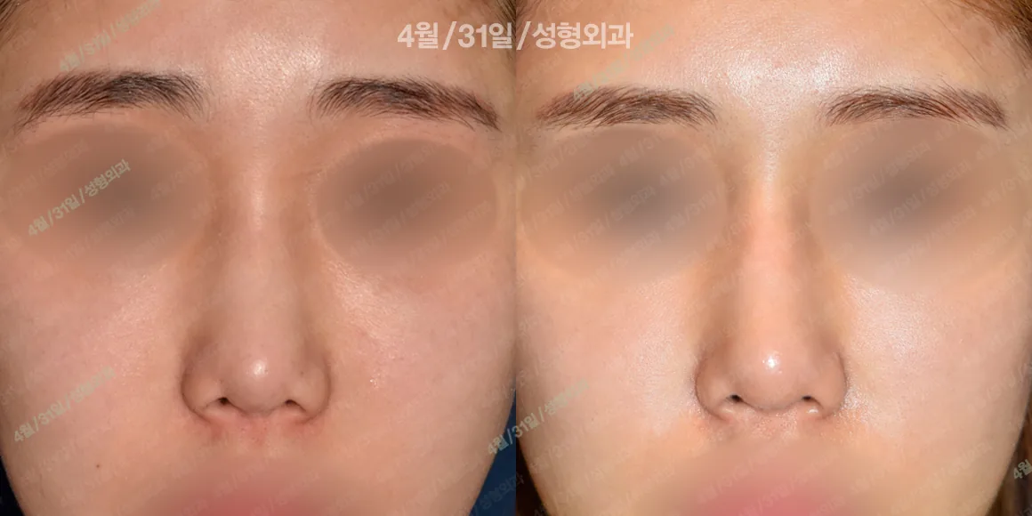 April 31美容外科 症例写真 2
