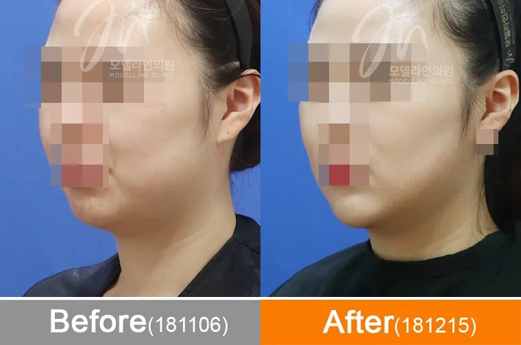 釜山Model Line面部吸脂术前术后案例