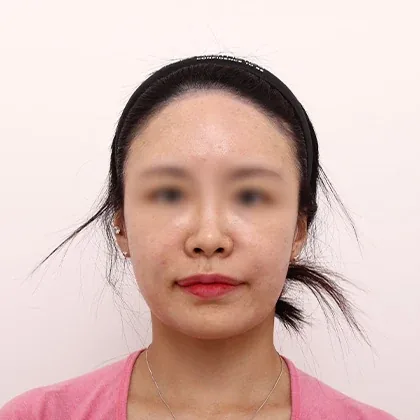 BOMON法令纹填充与肉毒素术后