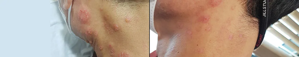 vanh颈侧皮肤治疗前后官方匿名记录