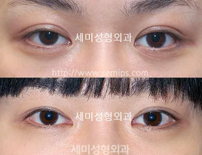 世美Marcus Gunn综合征眼部矫正案例