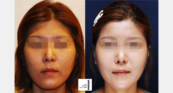 Luho自体脂肪移植加PRP术后1个月案例二